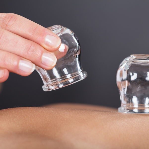 Close-up Of A Therapist Giving Cupping Treatment On Back