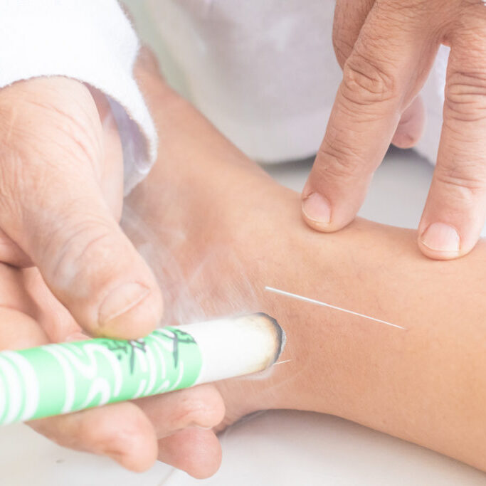 Woman being treated with acupuncture and moxibustion treatments. Close-up photo.